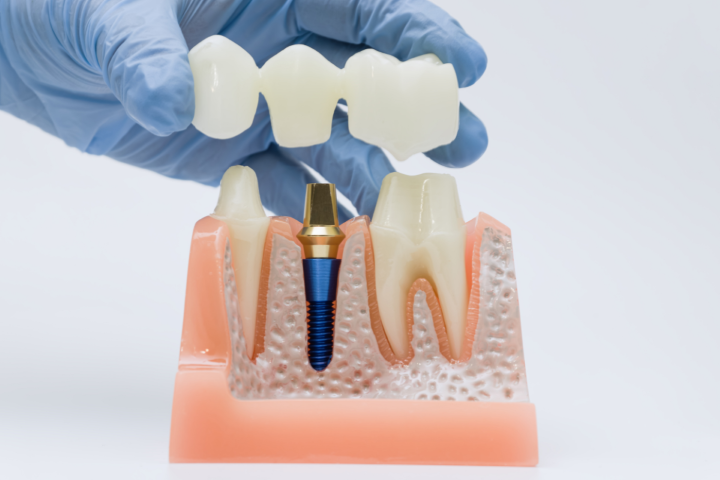Dr. Maria Smith restorative dentistry showing a dental bridge and implant model for expert tooth replacement in Shelton.